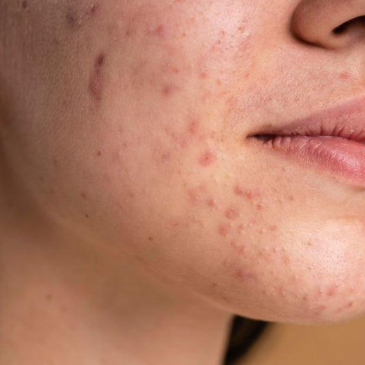 Can bedsheets cause acne?